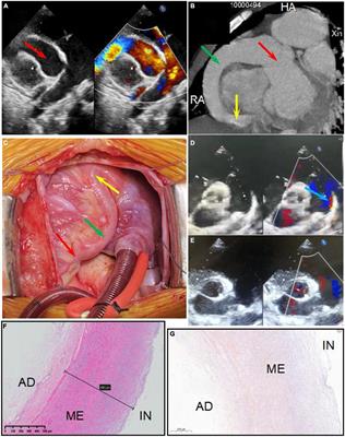 Two genetic variants in NEXN and ABCC6 genes found in a patient with right coronary artery to right ventricle fistula combined with giant coronary aneurysm and patent ductus arteriosus